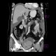 Ovarian carcinoma, carcinomatosis: CT - Computed tomography